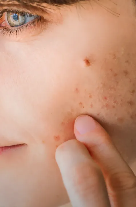 2.Biretix_TRIPLE IMAGE_Acne_713x1080 2.Biretix_TRIPLE IMAGE_Acne_713x1080
